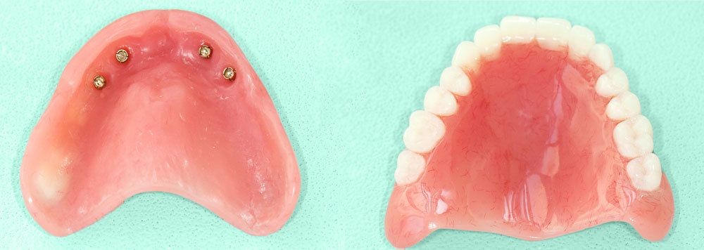 Types Of Partial Dentures Hendersonville PA 15339